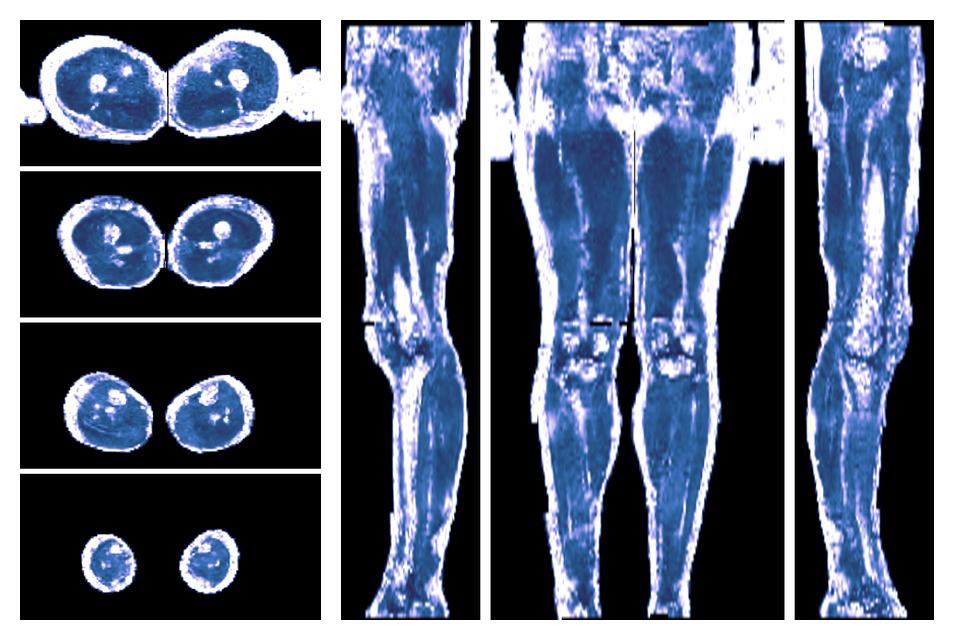 IVIM corrected whole leg muscle fractional anisotropy obtained from diffusion tensor imaging.
